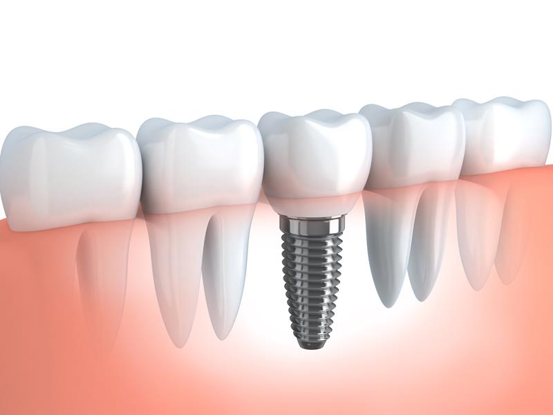 Dental Implants  Strasburg, PA 